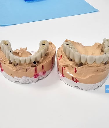 protesis sobre implantes