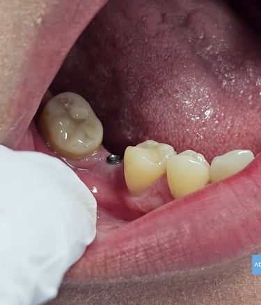 Servicio de implantes en Badajoz