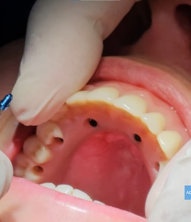 protesis sobre implantes