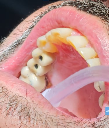 puente sobre implantes