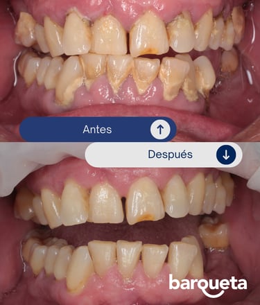 resultados de una limpieza dental profesional en sevilla
