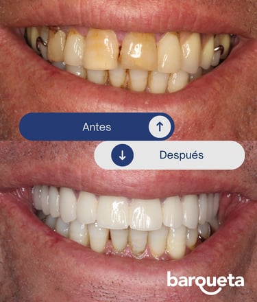 paciente satisfecho con sus carillas dentales