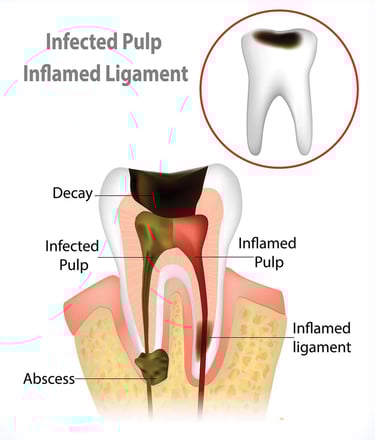 Root Canal Treatment in Navi Mumbai | Ekdantam Dental Clinic Navi Mumbai