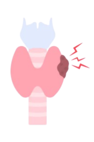 Hashimoto thyroiditis and homeopathy 