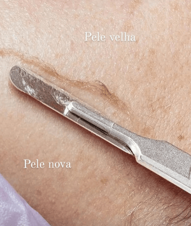 Dermaplaning em BH