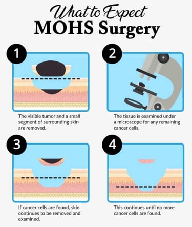 what to expect 4 steps about mohs surgery