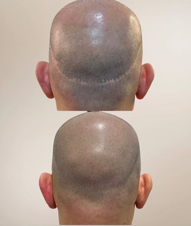Haarpigmentierung zur Kaschierung von FUT und FUE Narben