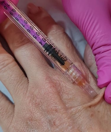 Rejuvenescimento das Mãos BH