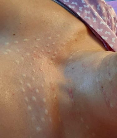 Rejuvenescimento de Colo em BH