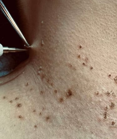 remover verrugas em bh