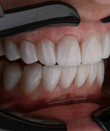 Dentalni turizam Srbija - moderna procedura izbeljivanja zuba u ordinaciji dr Đorđe Pavlović