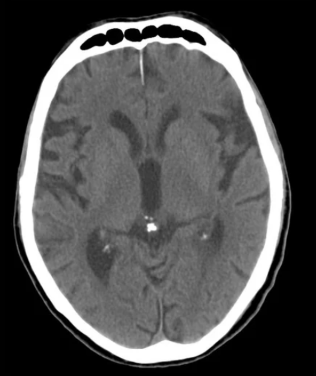 CT scan of calcified pineal gland showing mineral deposits affecting spiritual awakening and healing