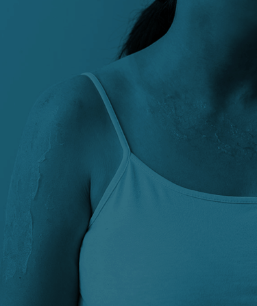 Tratamento de Queimaduras