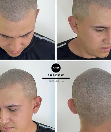 Résultat après micropigmentation capillaire chez un homme – densité naturelle.