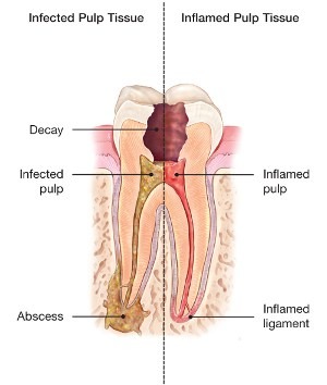 root canal treatment