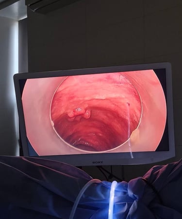 пухлина прямої кишки, ендоскопічне видалення новоутворення кишки, онкоколопроктолог, хірургія