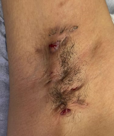 Hidradenite Supurativa, Salvador/Bahia