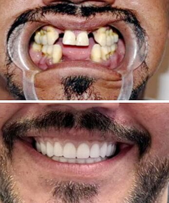 Severe tooth decay solved with permanent implant-supported dentures in Cancun