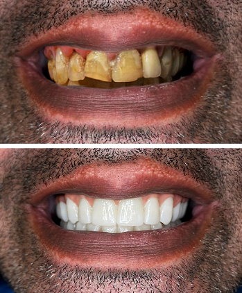 Before and after: Severe gum disease treated with All-On-4 zirconia bridges in Cancun
