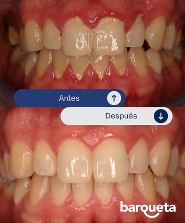 resultado tras tratamiento de periodoncia en sevilla