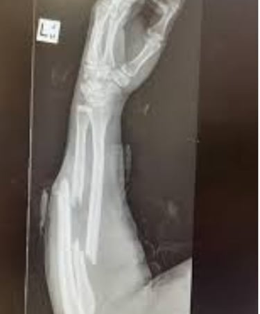 Why do some break when they fall down Without Getting Injured (1)