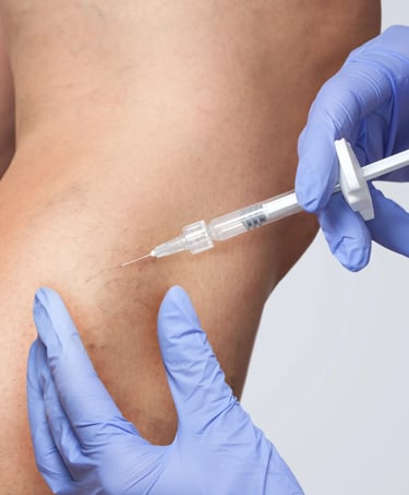 sclerotherapy in Amman by Dr. Omar Hamdallah