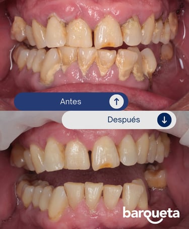 resultados de una limpieza dental profesional en sevilla