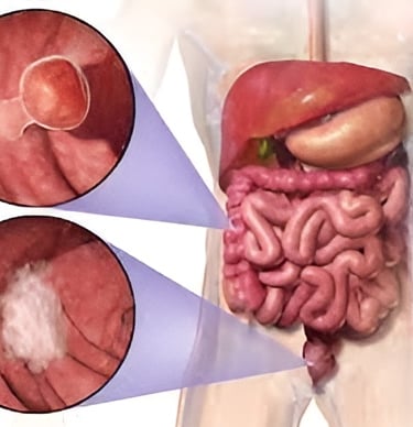 Imagen de Cáncer de Colon utilizado en la pagina web de la Dra. Arlenis Guzmán 