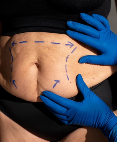 tummy tuck is a cosmetic surgery procedure used to make the abdomen thinner and more firm.