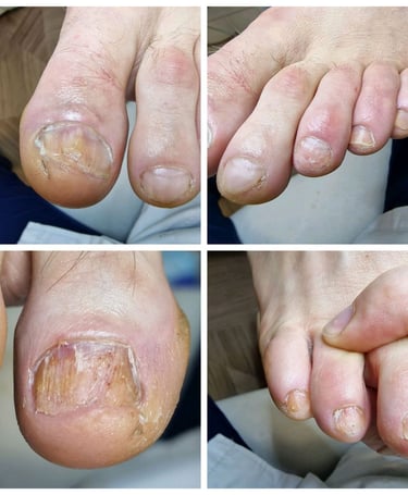 nagu grybelio valymas tarpinis gydymas