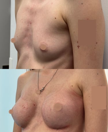 Breast augmentation (implant surgery) illustration from Macys Plastic Surgery Manchester