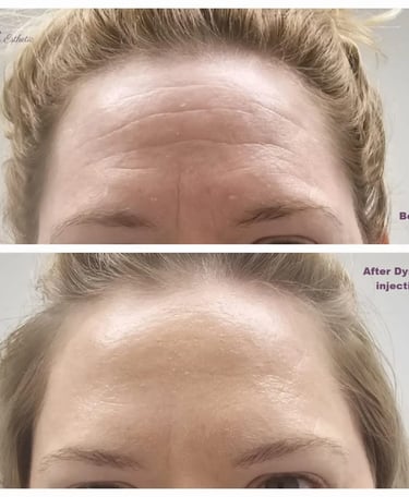 Dysport injection at Ariana Esthetic in Edmonton