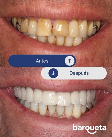 paciente satisfecho con sus carillas dentales