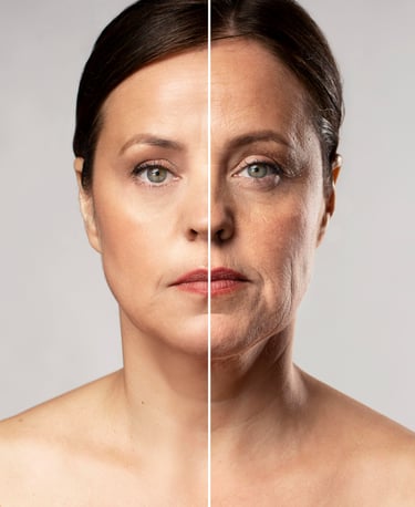 RF Microneedling comparison showing anti-aging treatment results on wrinkles and fine lines.