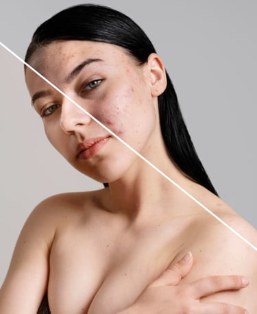 MIcroneedling skincare treatment comparison showing a woman's face with acne scars and clear skin.