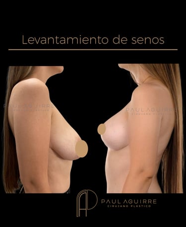 Cirujano plástico de senos Bogotá | Mastopexia