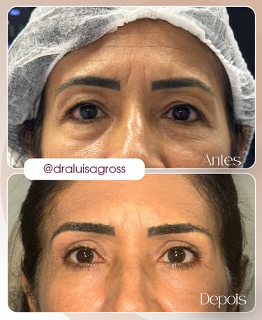 Antes e depois de cirurgia periocular realizada pela Dra. Luisa Gross