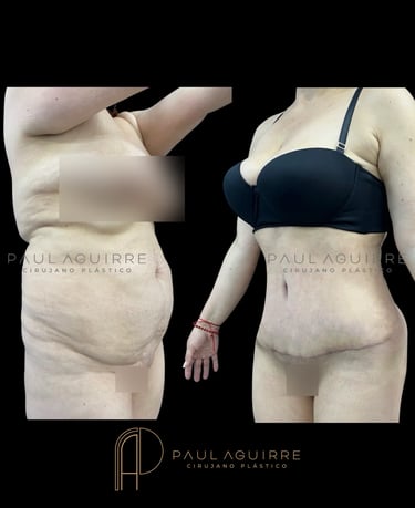 Cirujano plástico lipectomía Bogotá | Abdominoplastia