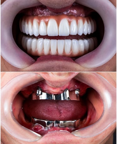 Reabilitação oral total sobre implantes dentários. Resultado de Engenharia Estética e precisão digit