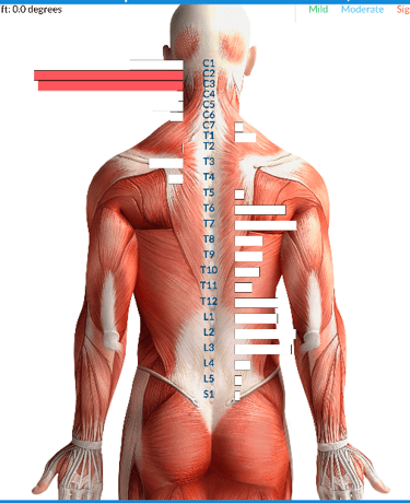 Vagus nerve stress from birth trauma causing tongue tie and latching issues