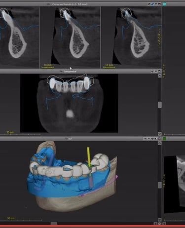 Implant Surgical guide design