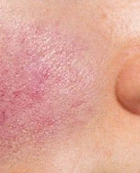 Rosacea in a young girl