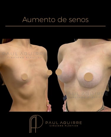 Cirujano plástico de aumento de senos Bogotá 1 Mamoplastia