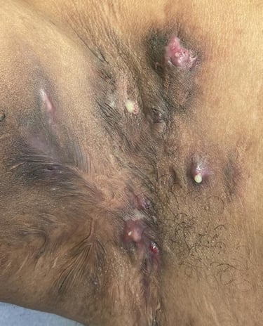 Hidradenite Supurativa, Salvador/Bahia 