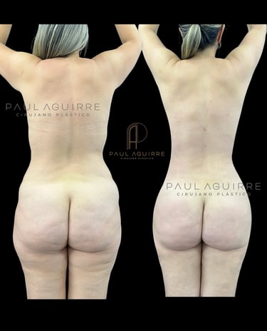 Cirujano plástico de lipo Bogotá | Lipoescultura