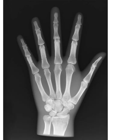 Hand Xray
