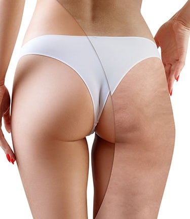 intradermoterapia para celulite