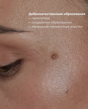 Удаление папилом