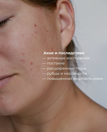 Лечение акне и разглаживание рубцов