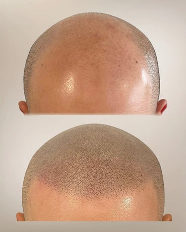 Scalp Micropigmentation Köln für realistischen Buzz-Cut-Effekt